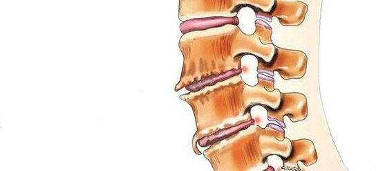 Spondylosis - Միջամտող հոդերի ոչնչացում