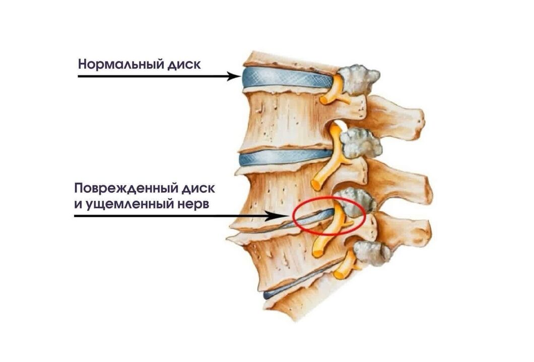 Արգանդի վզիկի օստեոխոնդրոզի ախտանիշները